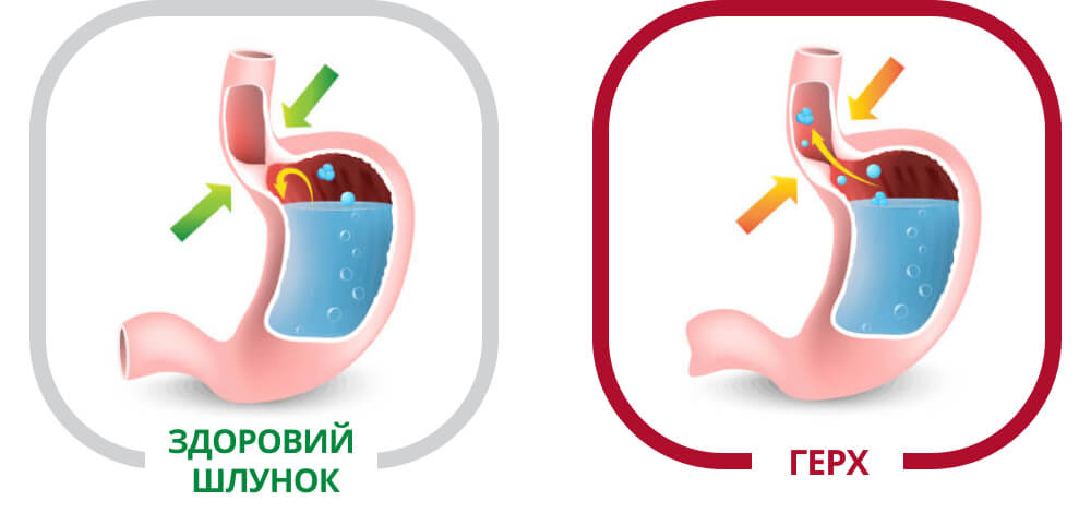 Печія та рефлюкс